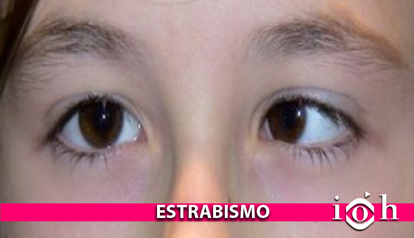 estrabismo