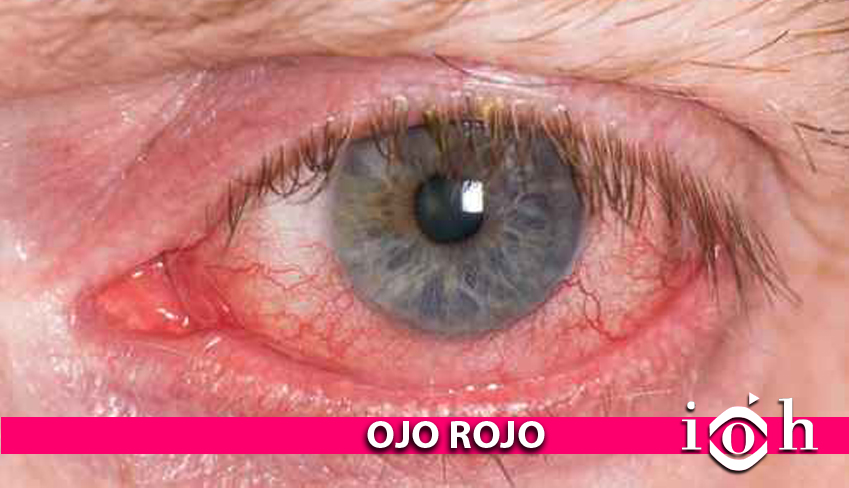 ojo rojo, como tratarlo
