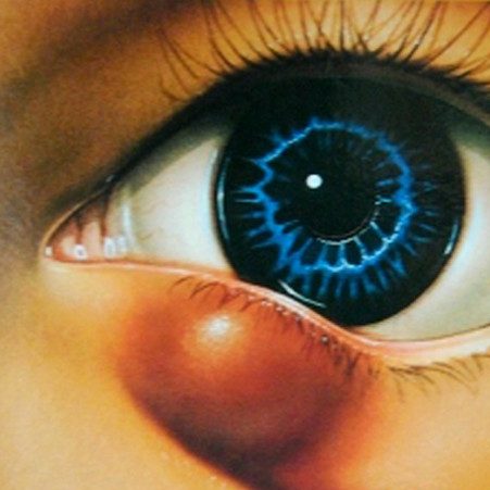 Orzuelos-y-CHALACIÓN1