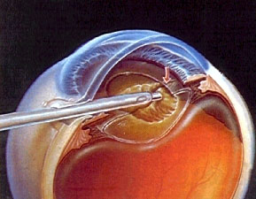 cataratas_IOH_OPERACION