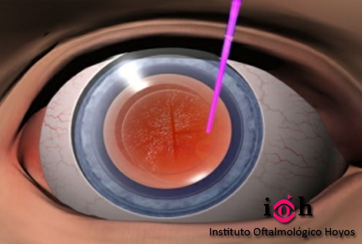 CAPSULOTOMÍA-YAG-Láser