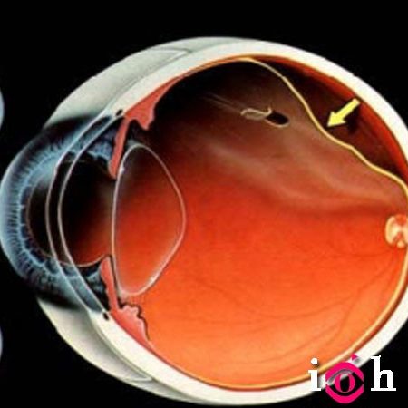 DESPRENDIMIENTO-de-retina