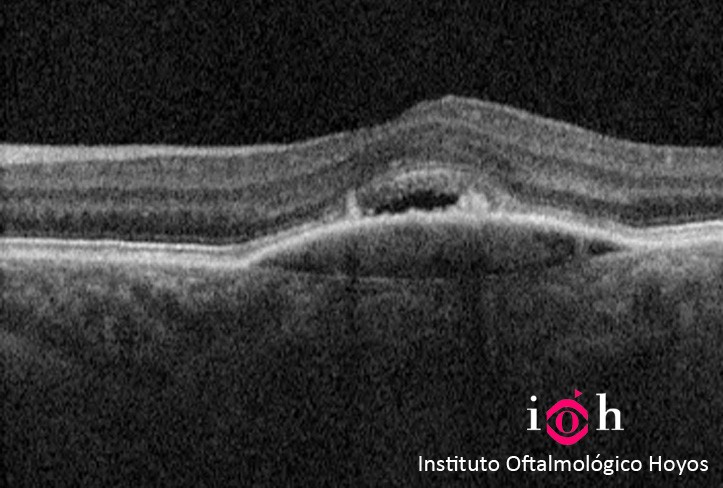 INYECCIONES-INTRAVÍTREA