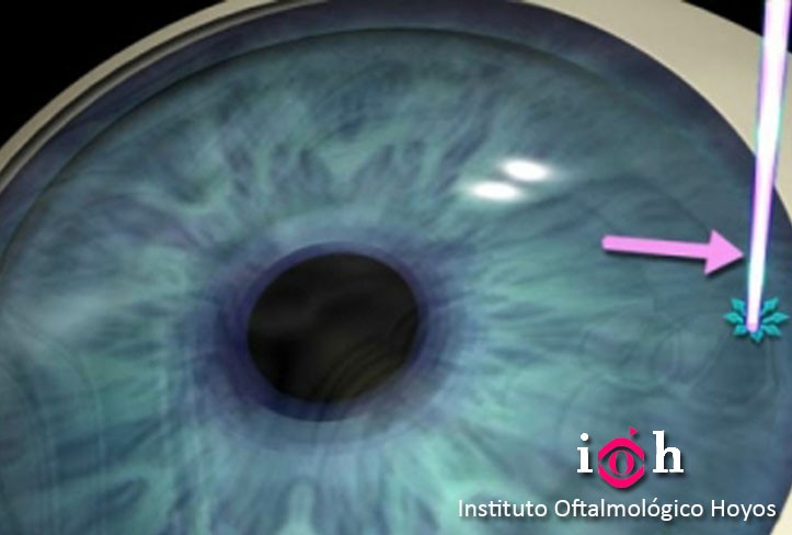 Iridotomía