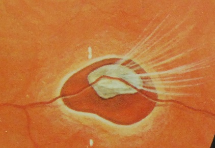 LASER DE RETINA desgarro