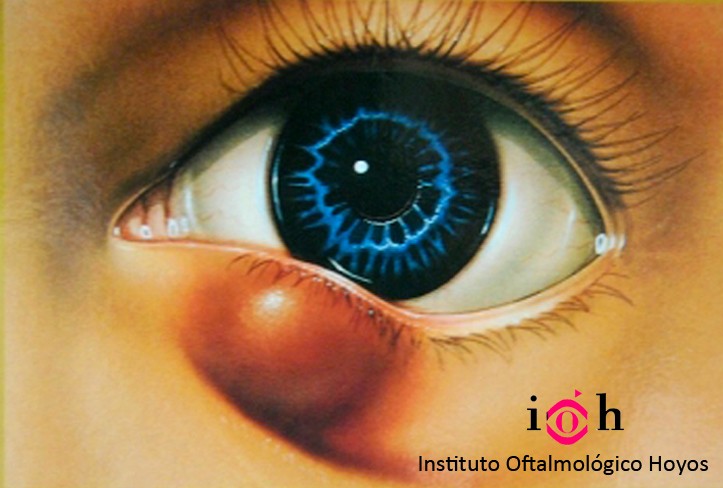 Orzuelos-y-CHALACIÓN1