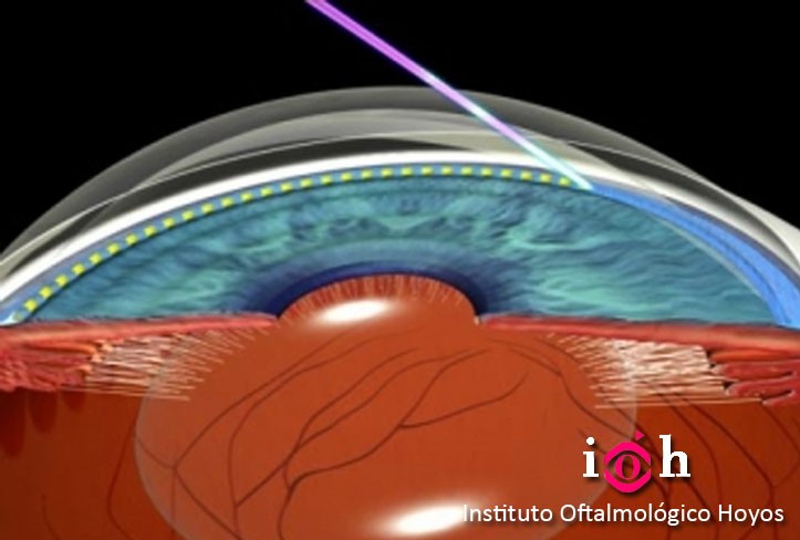 TRABECULOPLASTIA-LÁSER