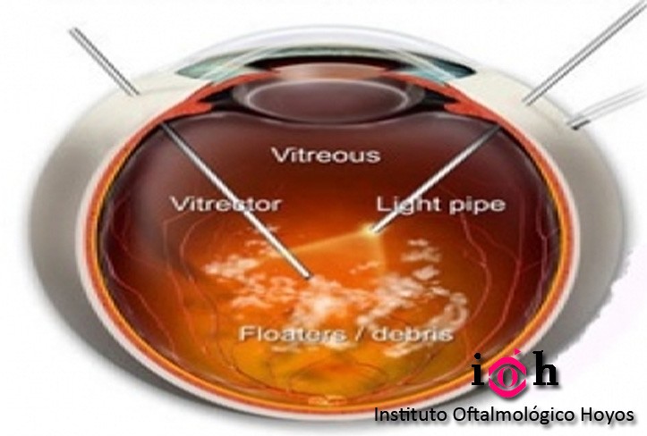 VITRECTOMÍA