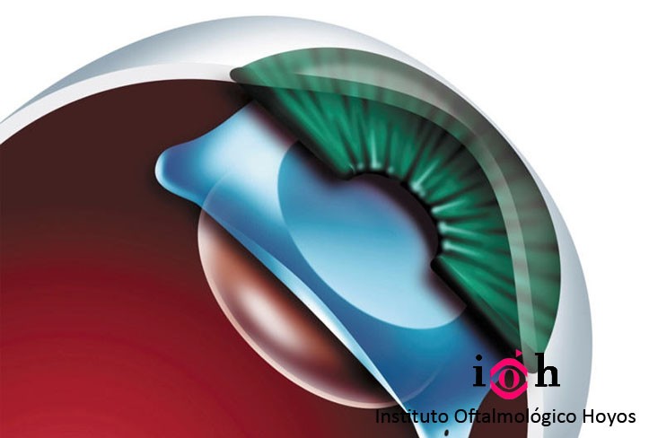 implante lente visian icl