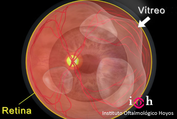 retina y vitreo
