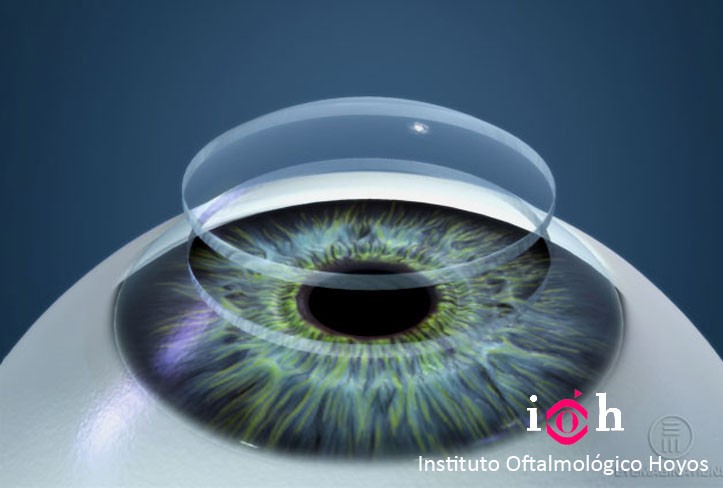 trasplante de cornea