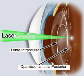 Capsulotomia YAG laser