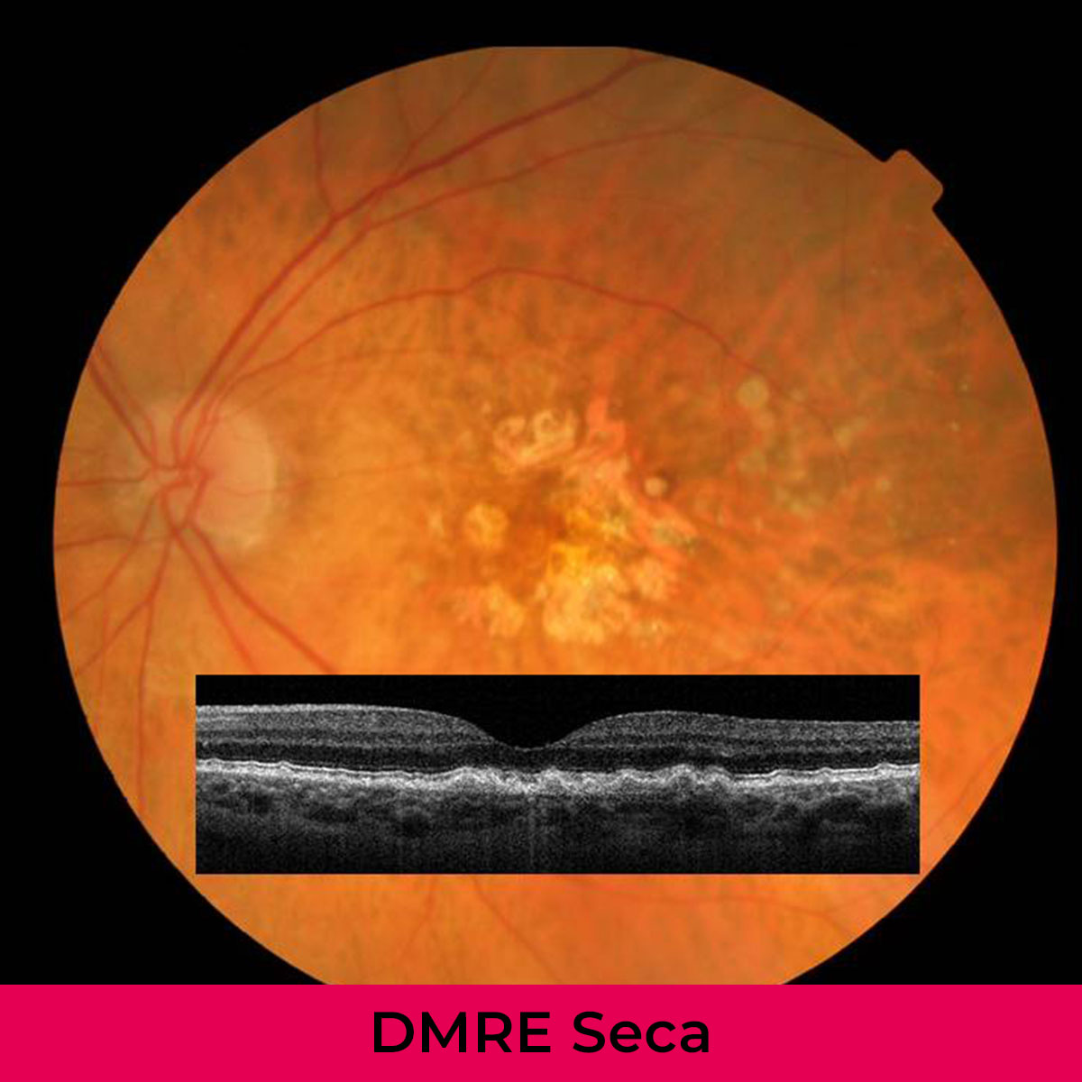 DMRE Seca