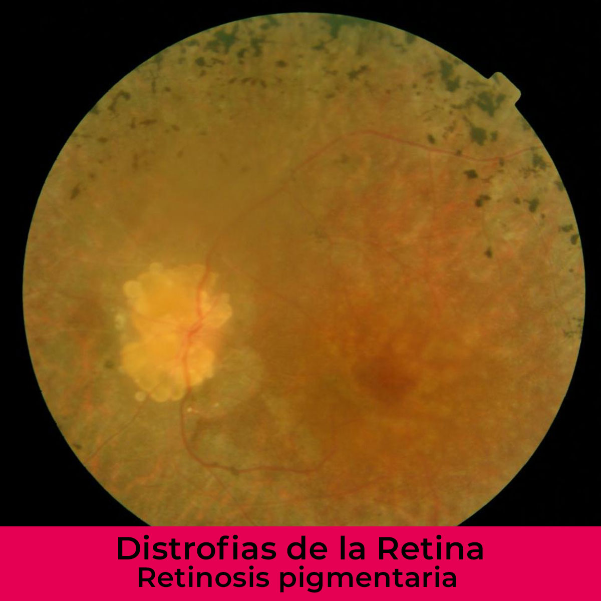 distrofias-de-la-retina-iohoyos