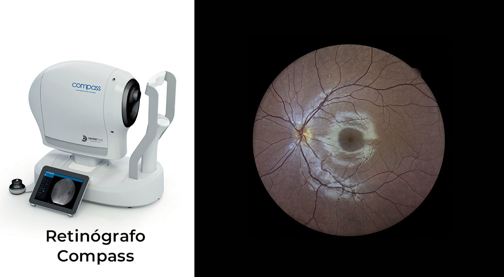 Retinógrafo Compass
