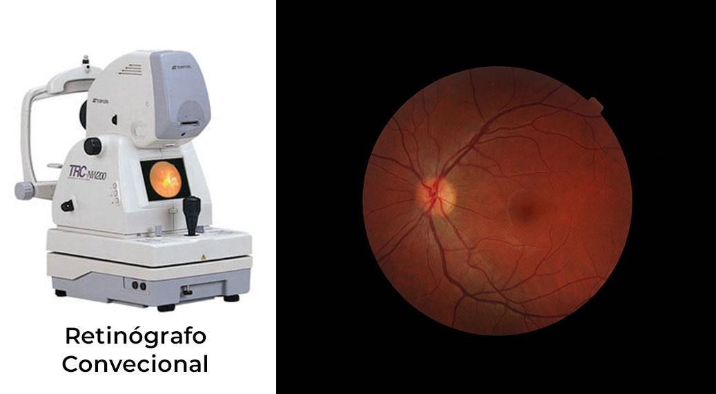 Retinógrafo Convencional