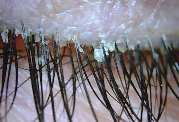 cómo evitar la blefaritis? Instituto Oftalmológico Hoyos en Sabadell