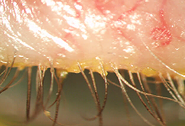 cómo evitar la blefaritis? Instituto Oftalmológico Hoyos en Sabadell