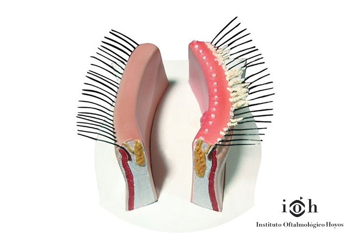 tratar-la-blefaritis y cómo prevenir la blefaritis