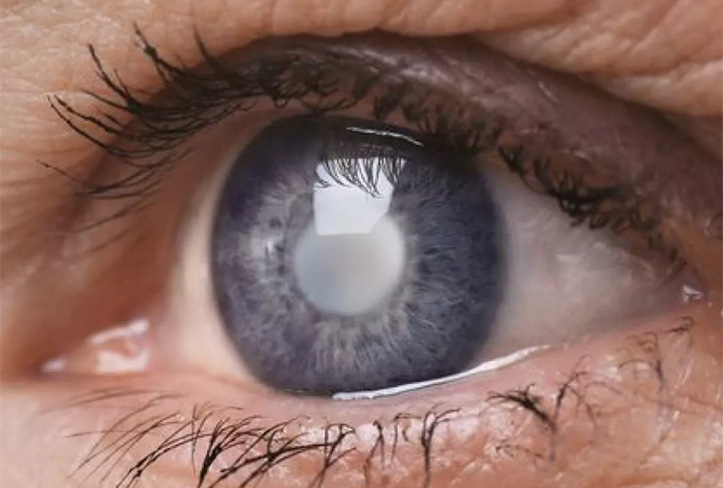 cirugía de cataratas