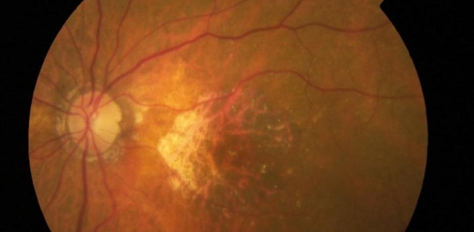 Degeneración macular