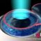 LÁSER-Excimer-LASIK Lasik