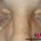 XANTELASMA XANTELASMA