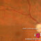 cirurgia glaucoma cirurgia glaucoma