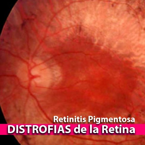 distrofias de la retina