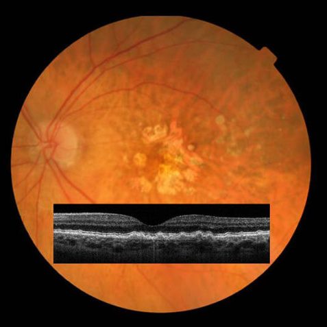 enfermedades-maculares-hoyos-oftalmologia-sabadell-637×478