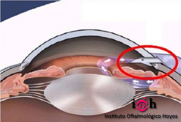 implante-de-drenaje