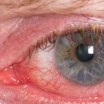 patologias oculares