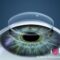 trasplante de cornea trasplante de cornea