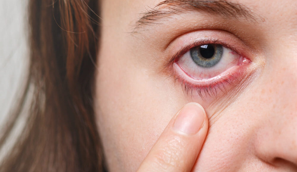 Inflamación ocular: causas frecuentes, síntomas de alarma y cuándo acudir al oftalmólogo
